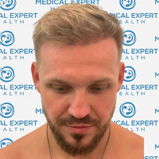 Before & After Results - After