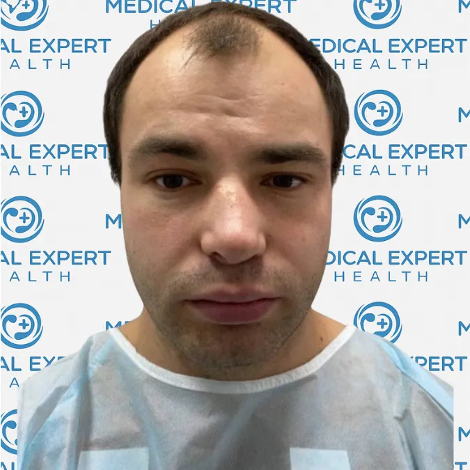 FUE Hair Transplant · Before and after - Before