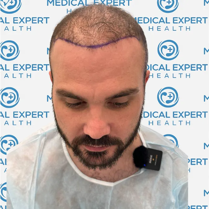 FUE Hair Transplant · Before and after - Before