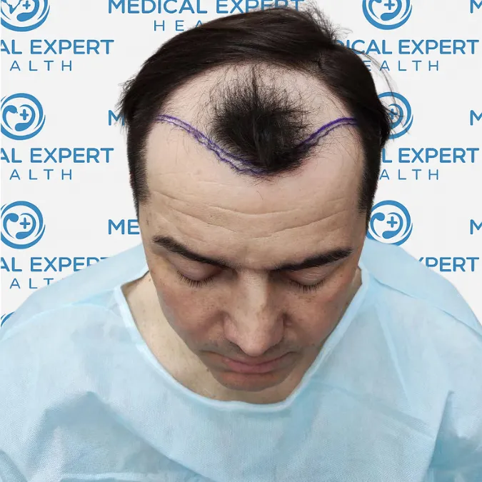 FUE Hair Transplant · Before and after - Before