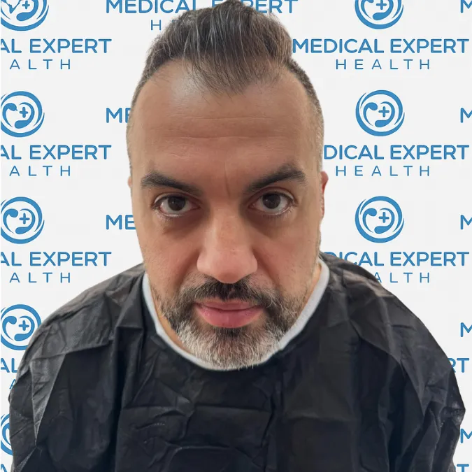 FUE Hair Transplant · Before and after - Before