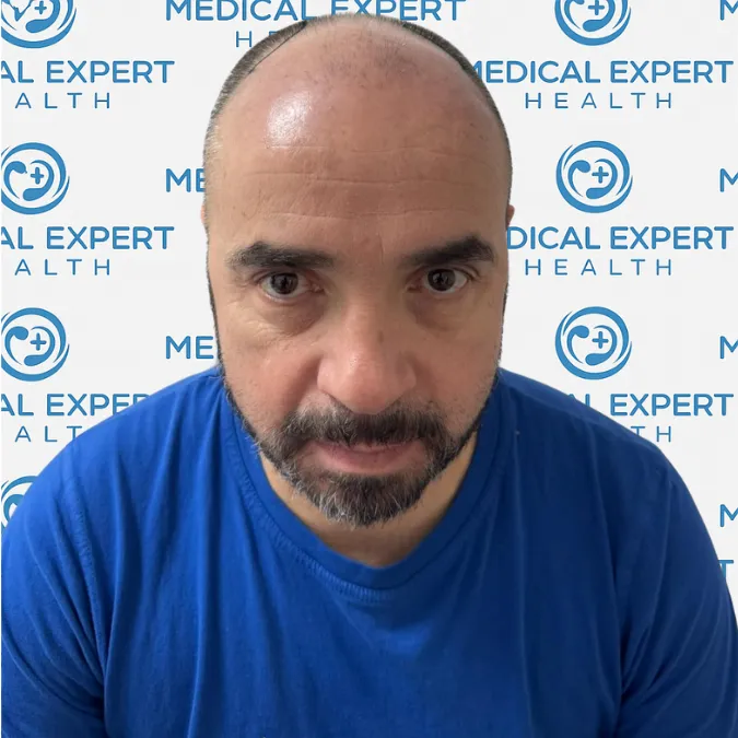 FUE Hair Transplant · Before and after - Before