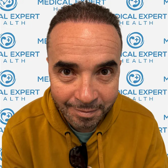FUE Hair Transplant · Before and after - After