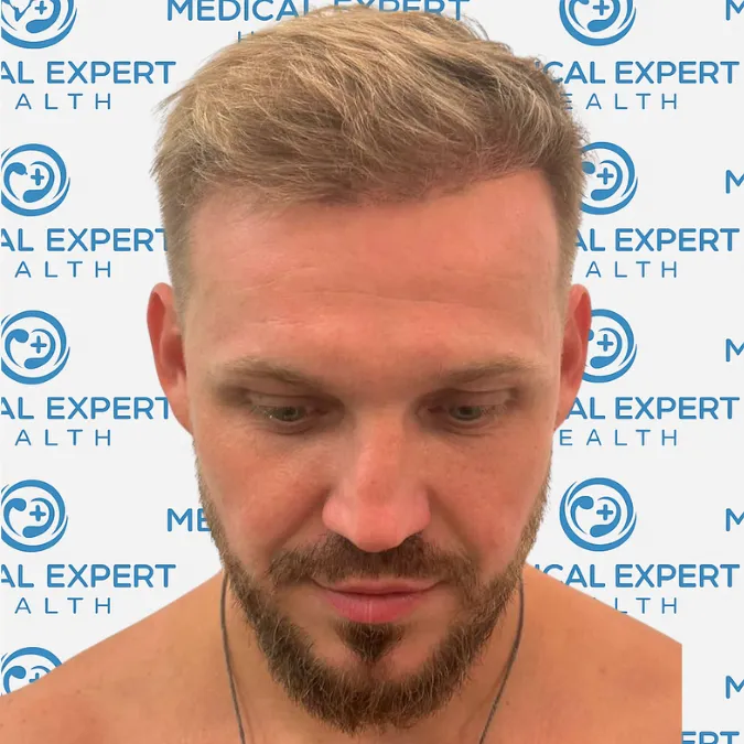 FUE Hair Transplant · Before and after - After